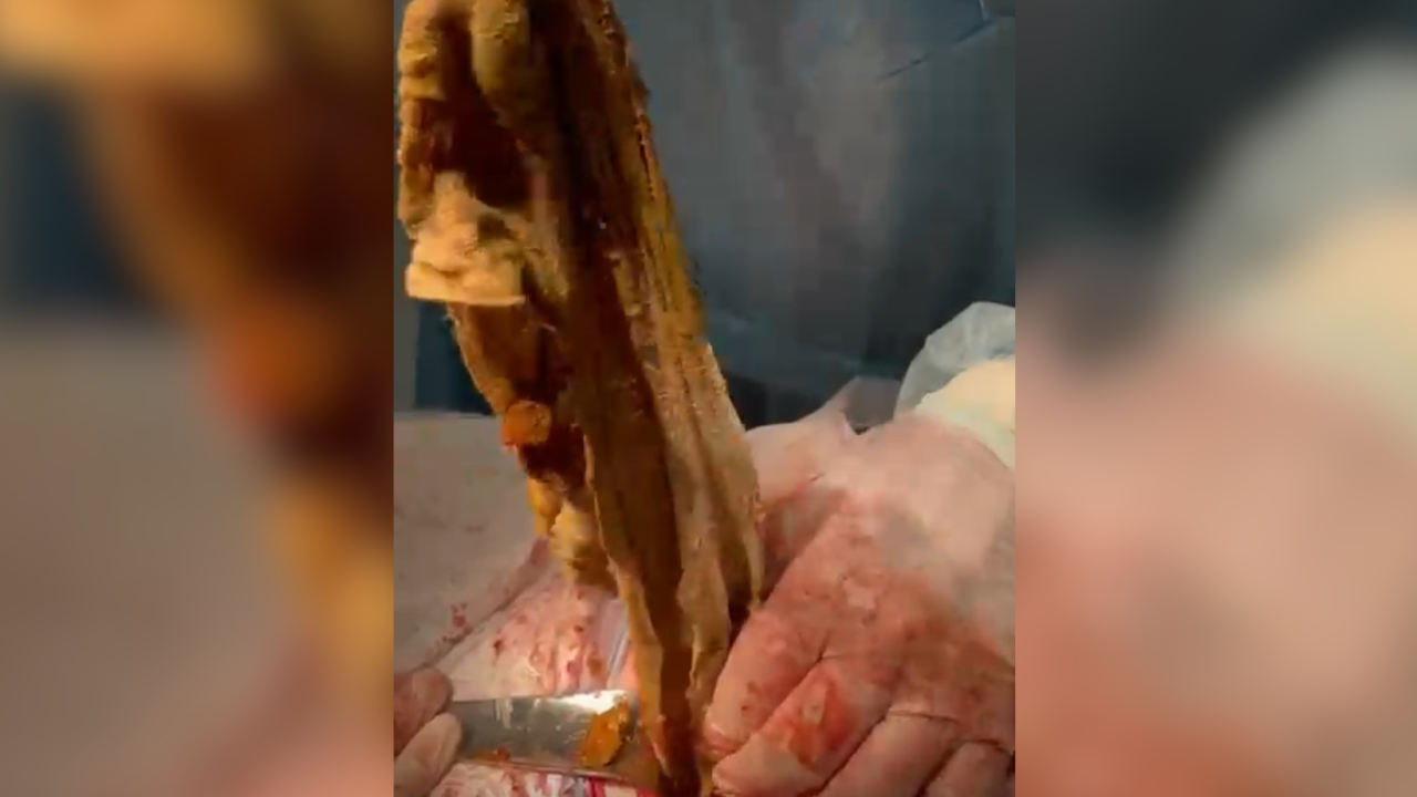 «Құрсағында 9 ай салфетка жатқан»: Алматыда дәрігерлер өлім аузындағы әйелді әрең құтқарды