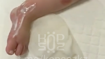 В Астане во время лечения младенец получил ожог ноги (ВИДЕО)