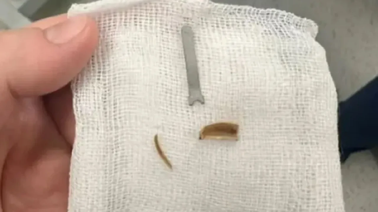 Ақтауда 11 айлық сәбидің өкпесінен темір бөлшек алынды (ВИДЕО)