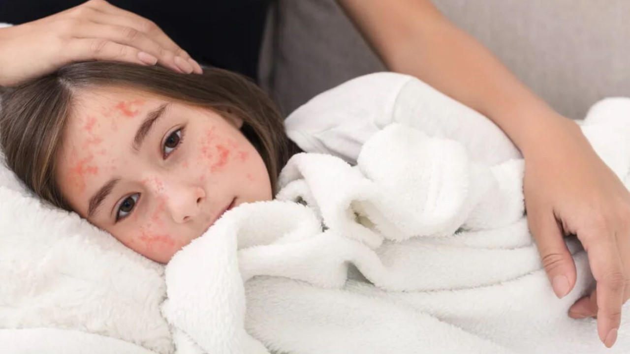 В Астане не будут госпитализировать детей непривитых от кори