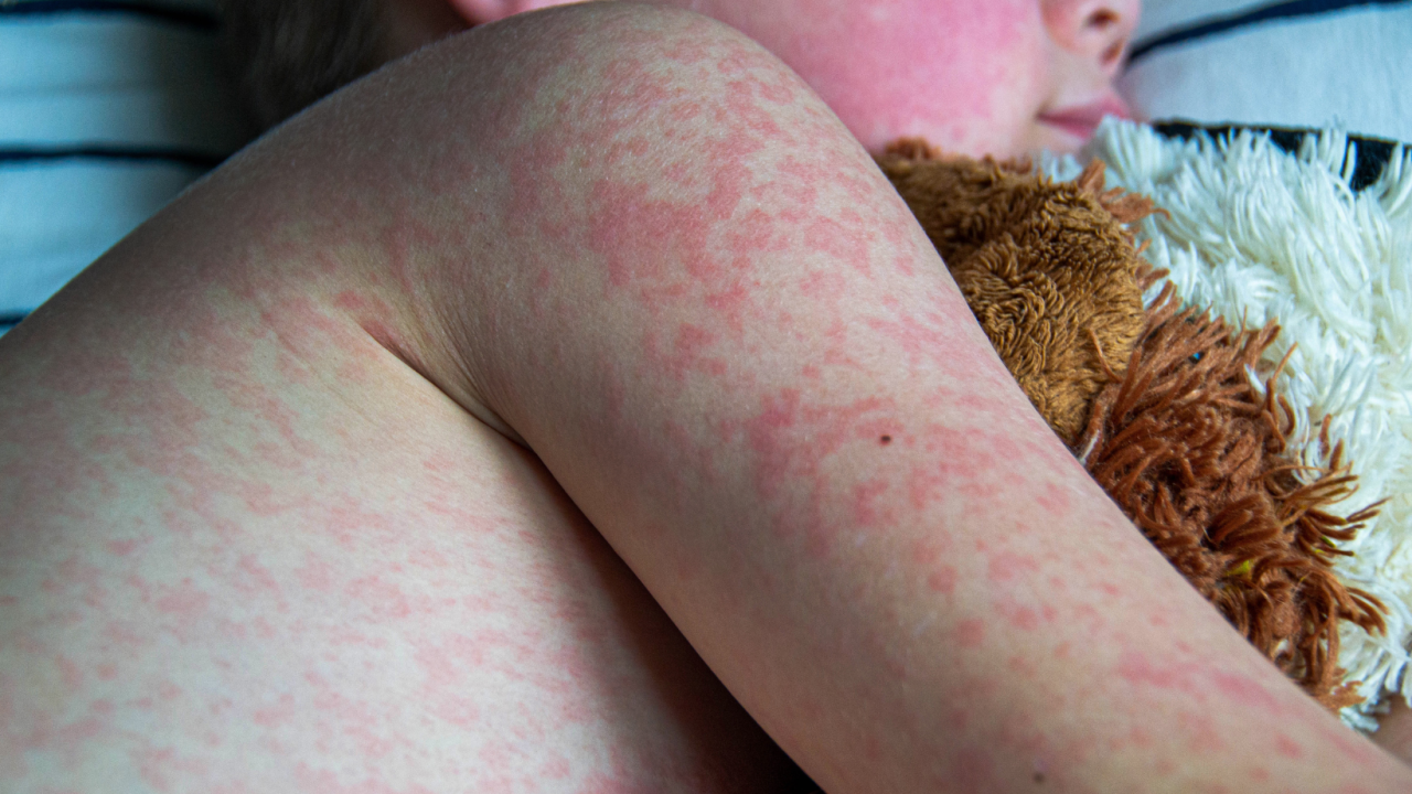 Елімізде 2 мыңға жуық адам қызылшамен ауырған