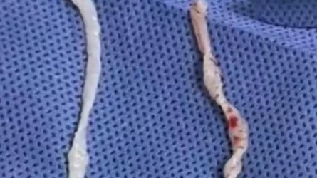 Бір жыл бойы қолы ауырған әйелден 10 см-лік құрт шықты